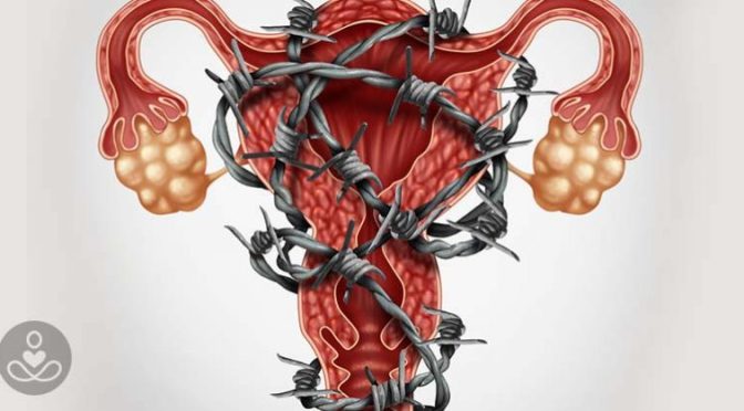 Can Aromatase Inhibitors and/or Surgery Relieve Endometriosis in Women?